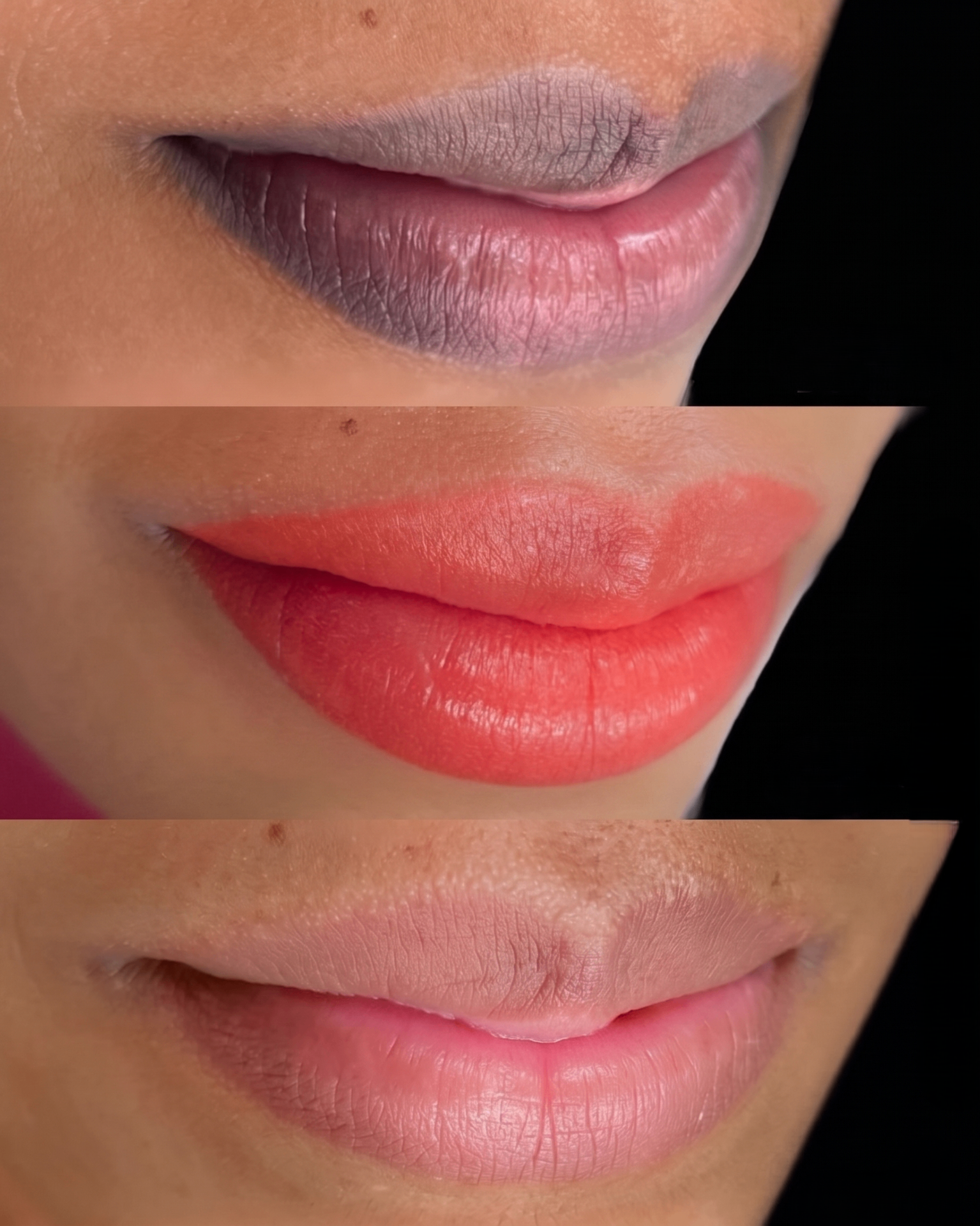 Antes & Depois — Neutralização Labial - cicatrizado